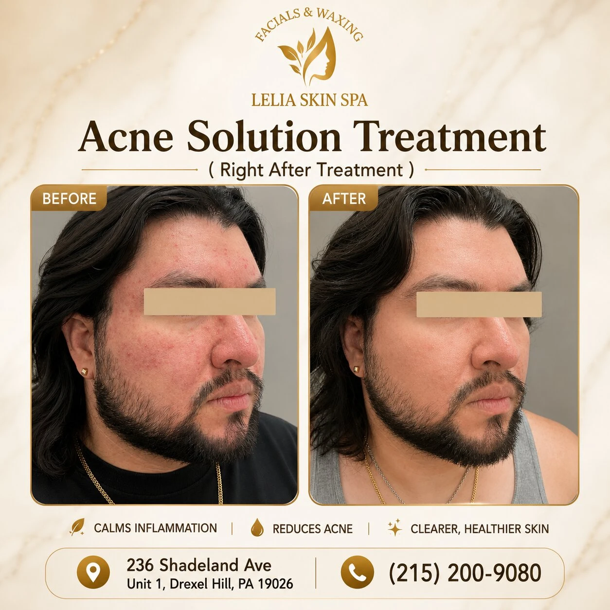 acnes solution